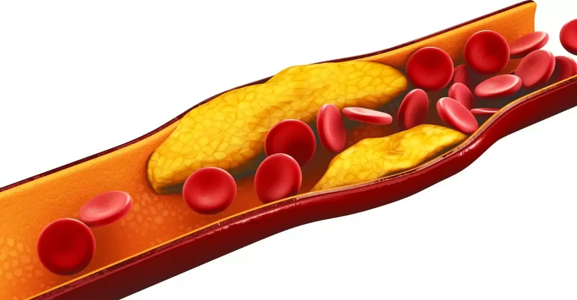 O motivo para tomar cápsulas MiCardium é a aterosclerose vascular